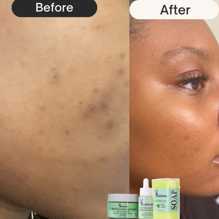 Acne Prone Skin Clarifying Bundle